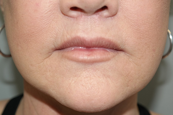 Lip Lift Before and After | Grover Aesthetics