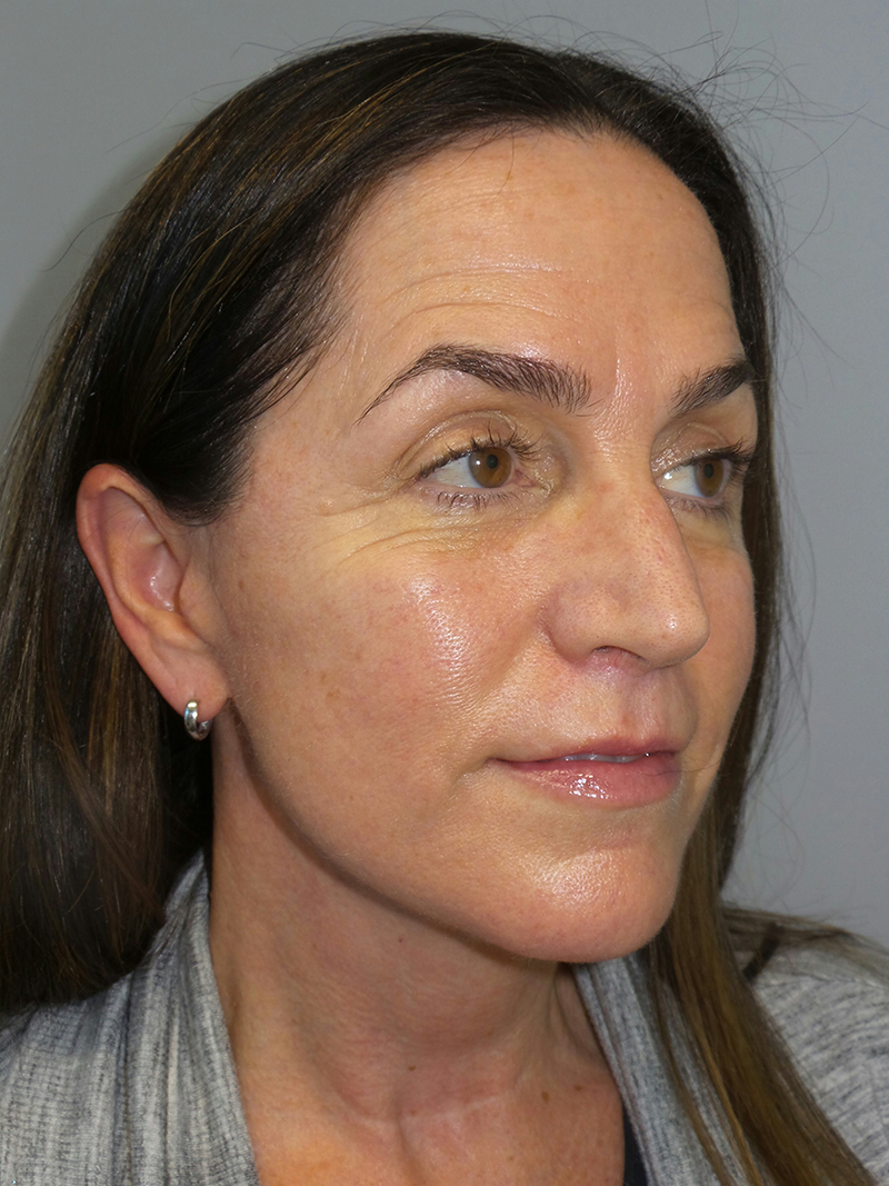 Lip Lift Before and After 10 | Grover Aesthetics