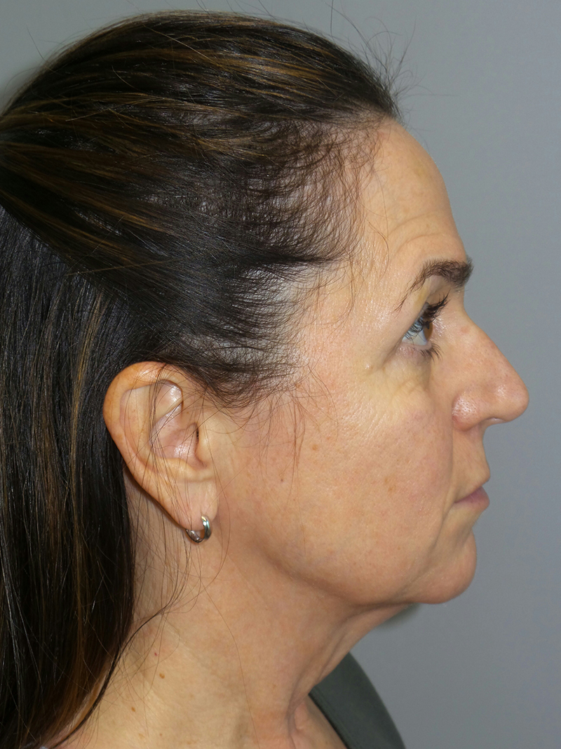 Lip Lift Before and After 10 | Grover Aesthetics