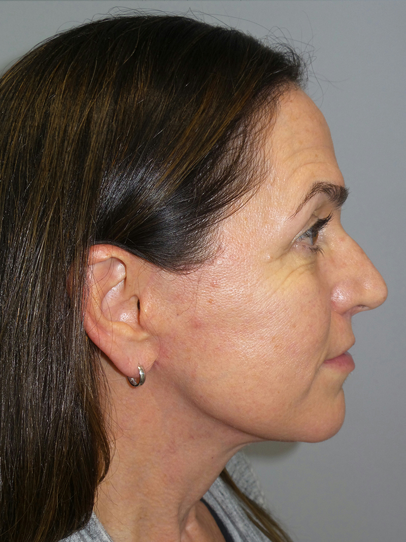 Lip Lift Before and After 10 | Grover Aesthetics