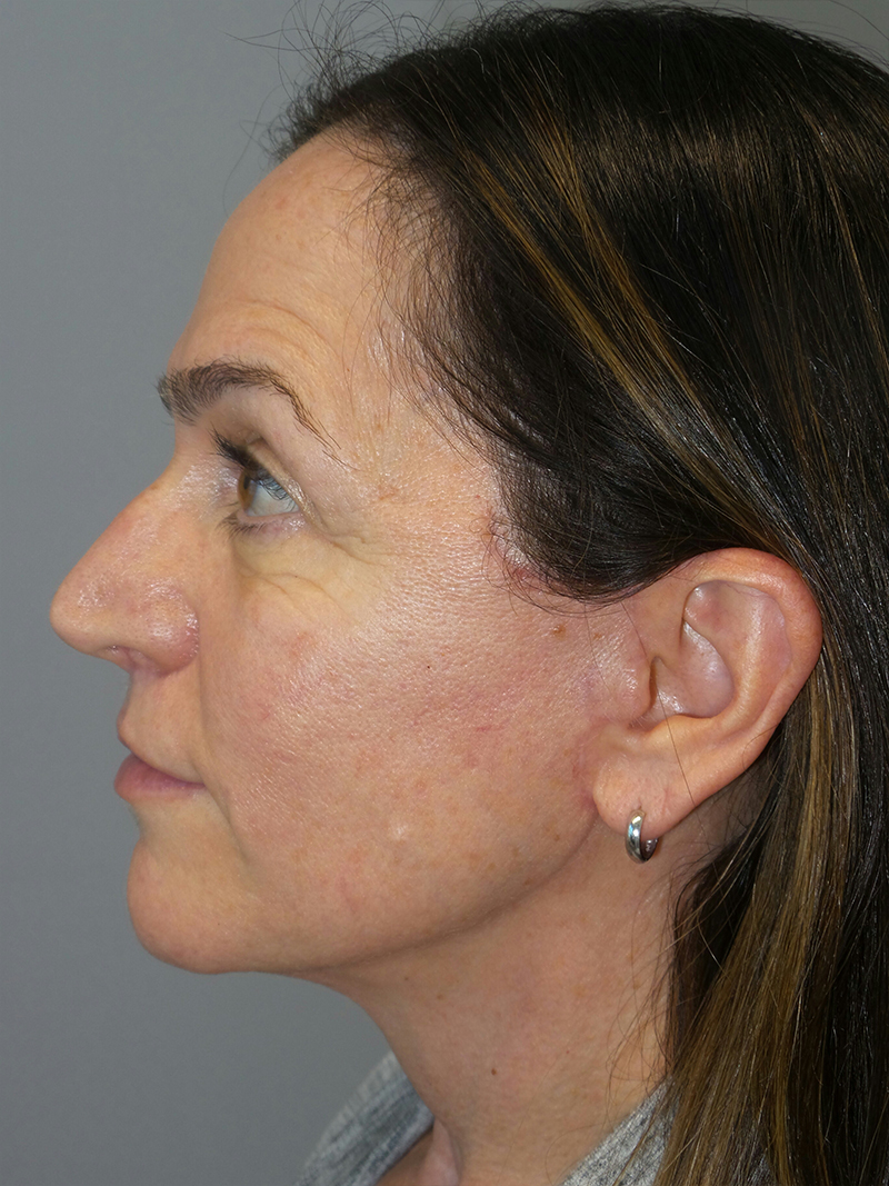 Lip Lift Before and After 10 | Grover Aesthetics