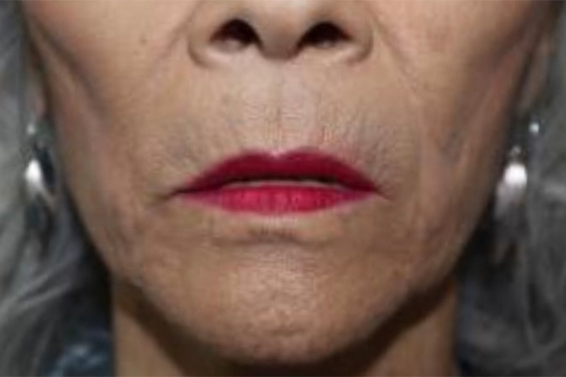 Lip Lift Before and After | Grover Aesthetics