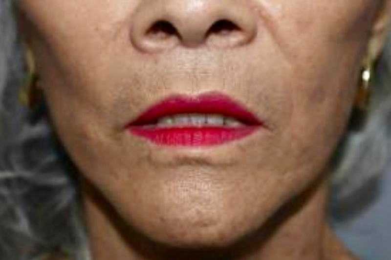 Lip Lift Before and After | Grover Aesthetics