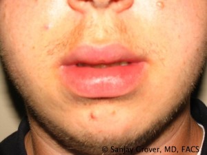 Male Lip Reduction Before and After 01 | Sanjay Grover MD FACS