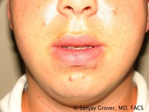 Male Lip Reduction Before and After 01 | Sanjay Grover MD FACS