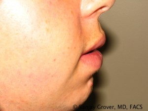 Male Lip Reduction Before and After 01 | Sanjay Grover MD FACS