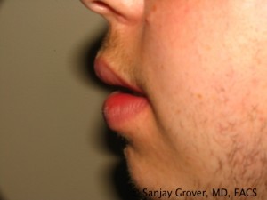 Male Lip Reduction Before and After 01 | Sanjay Grover MD FACS