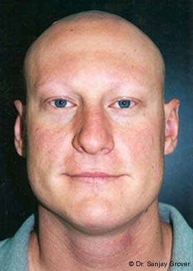 Otoplasty Before and After | Grover Aesthetics
