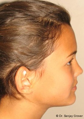 Otoplasty Before and After 04 | Grover Aesthetics