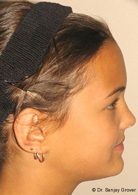 Otoplasty Before and After 04 | Grover Aesthetics