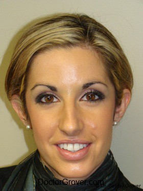 Otoplasty Before and After | Grover Aesthetics