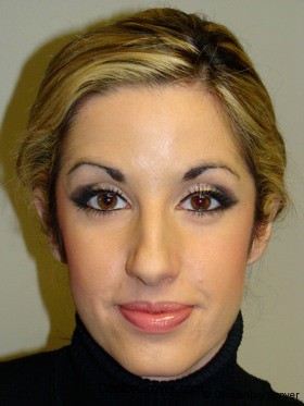 Otoplasty Before and After | Grover Aesthetics