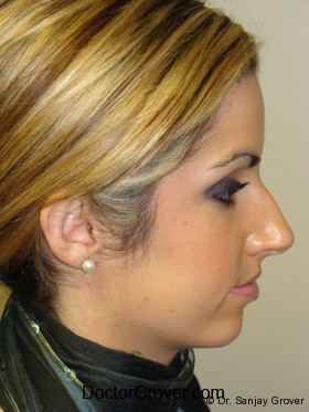Otoplasty Before and After 05 | Grover Aesthetics