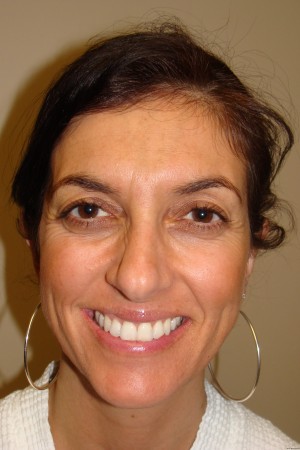 Otoplasty Before and After | Grover Aesthetics