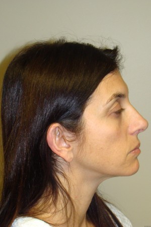 Otoplasty Before and After 06 | Grover Aesthetics