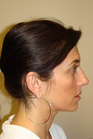 Otoplasty Before and After 06 | Grover Aesthetics