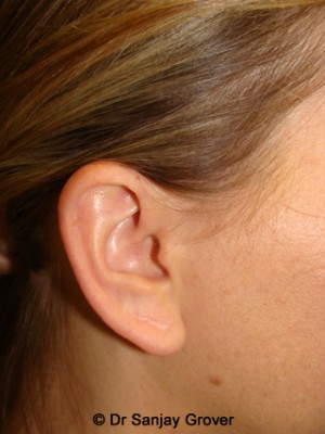 Otoplasty Before and After | Grover Aesthetics