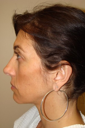 Otoplasty Before and After 07 | Grover Aesthetics