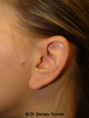 Otoplasty Before and After 08 | Grover Aesthetics