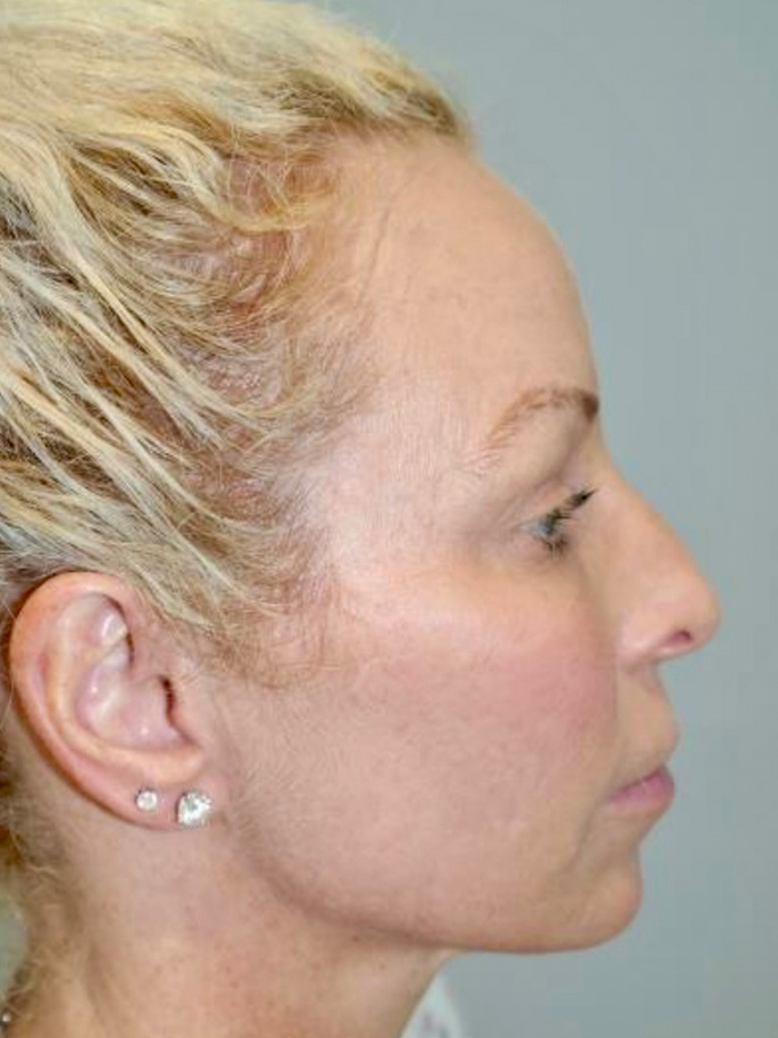 Rhinoplasty Before and After 38 | Sanjay Grover MD FACS