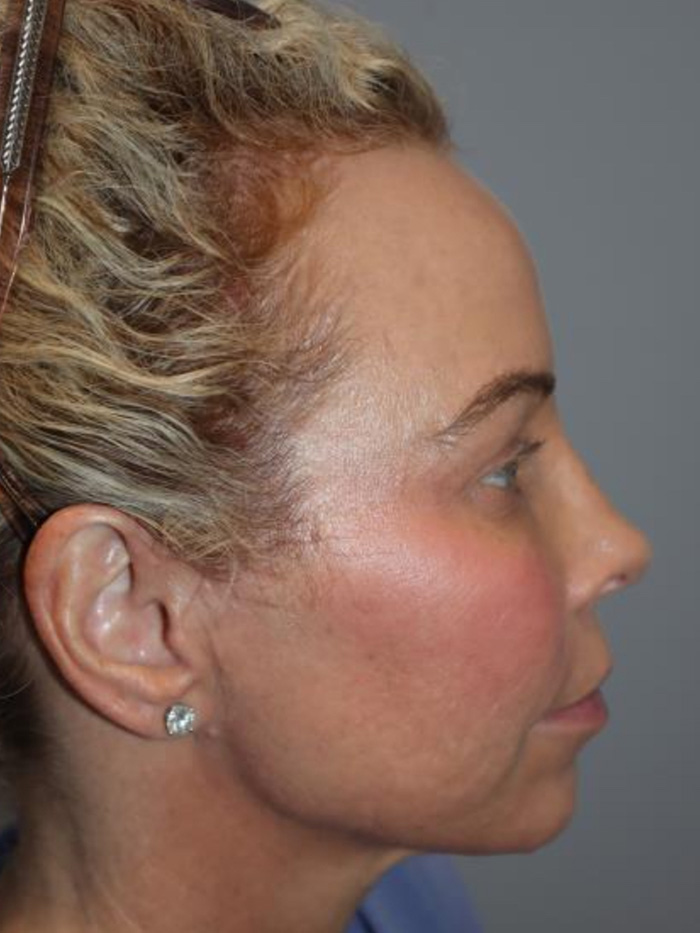 Rhinoplasty Before and After | Sanjay Grover MD FACS