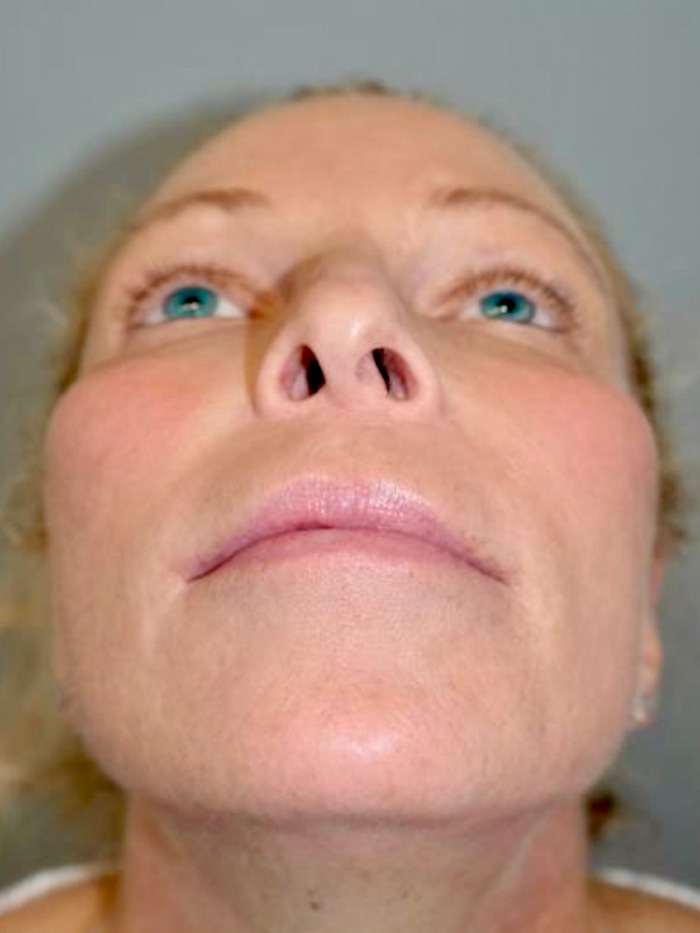 Rhinoplasty Before and After 01 | Grover Aesthetics