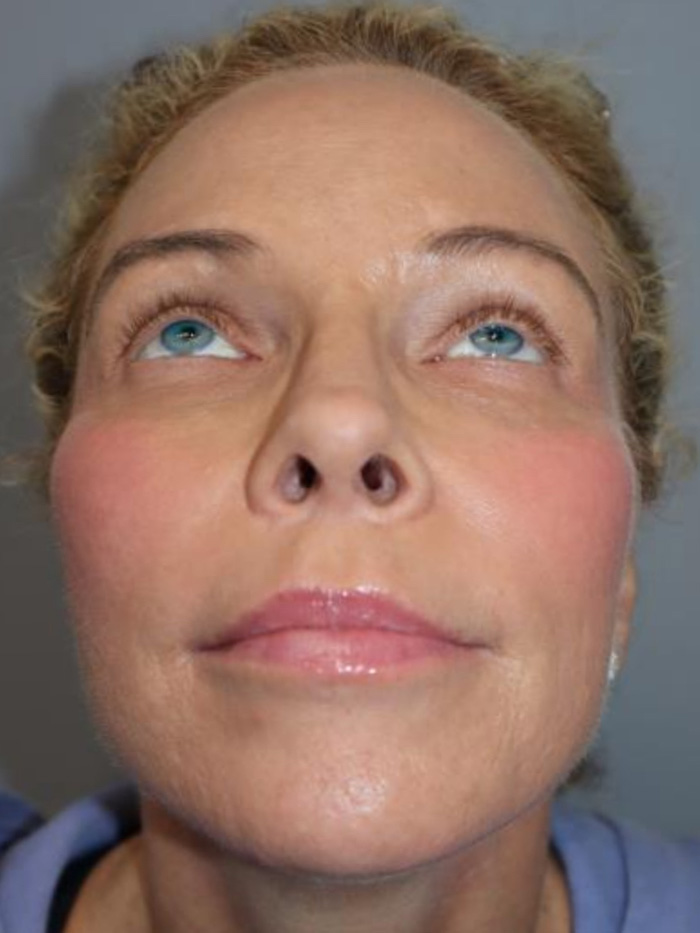 Rhinoplasty Before and After 01 | Grover Aesthetics