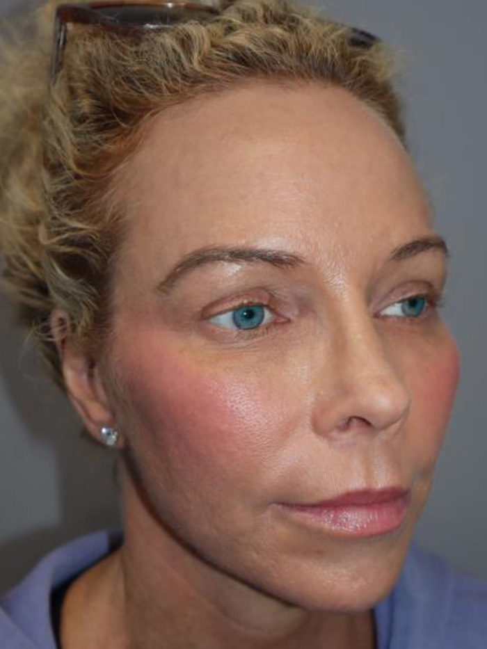 Rhinoplasty Before and After 01 | Grover Aesthetics