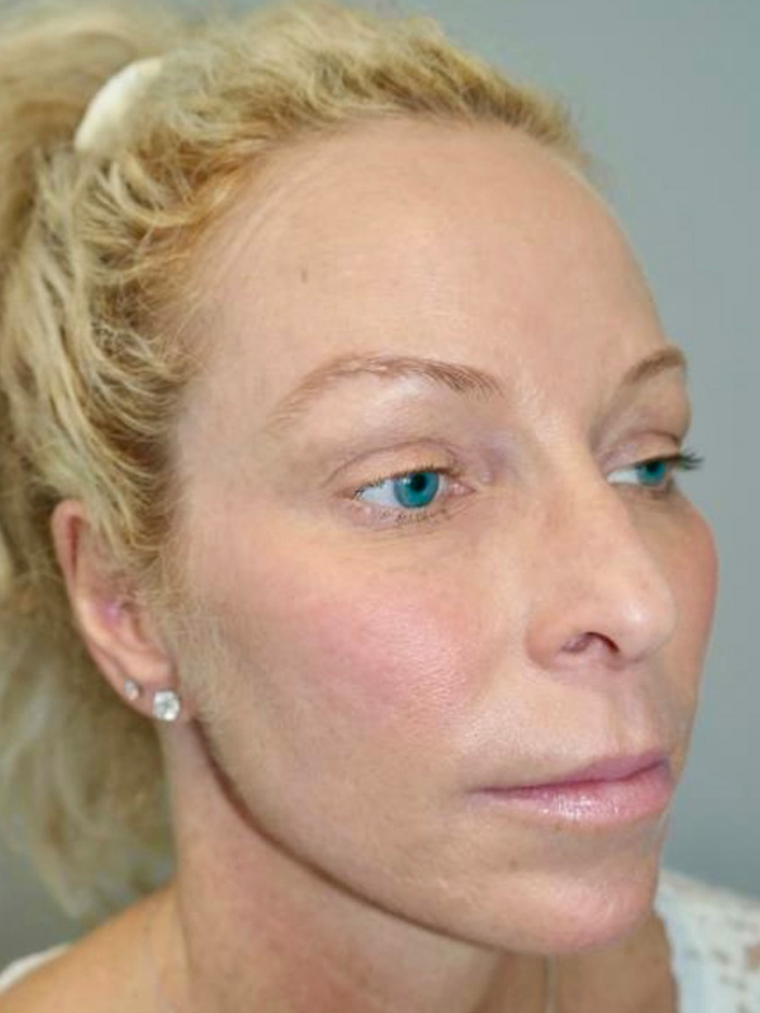 Rhinoplasty Before and After 01 | Grover Aesthetics