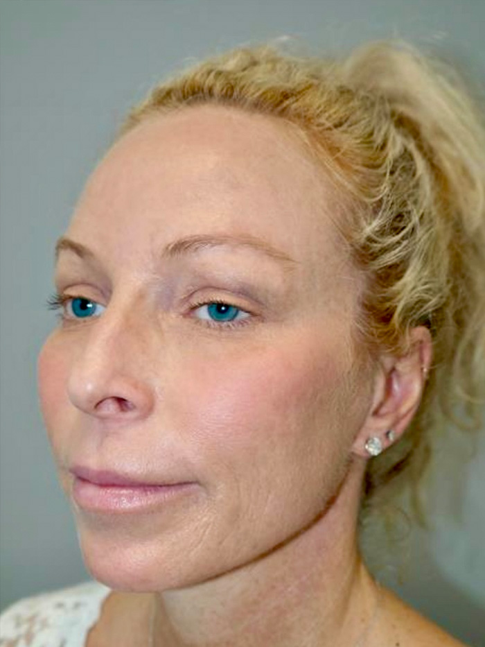 Rhinoplasty Before and After 01 | Grover Aesthetics