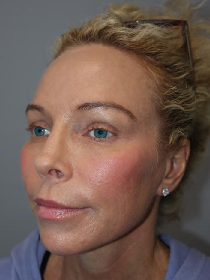 Rhinoplasty Before and After 01 | Grover Aesthetics