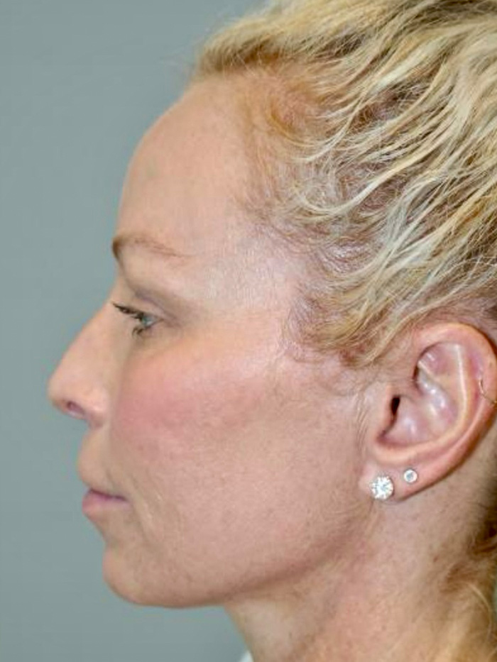 Rhinoplasty Before and After 01 | Grover Aesthetics