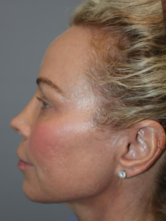 Rhinoplasty Before and After 01 | Grover Aesthetics