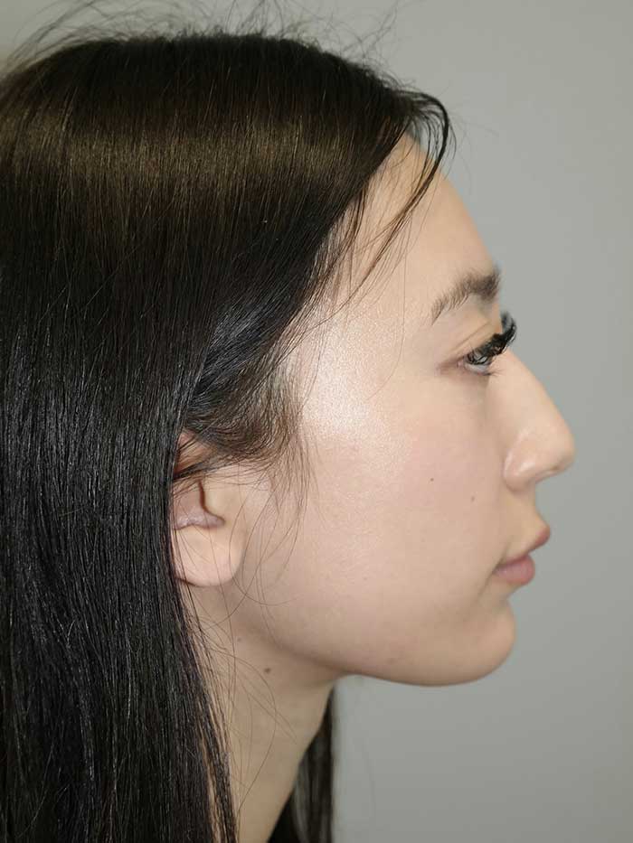 Rhinoplasty Before and After 45 | Sanjay Grover MD FACS