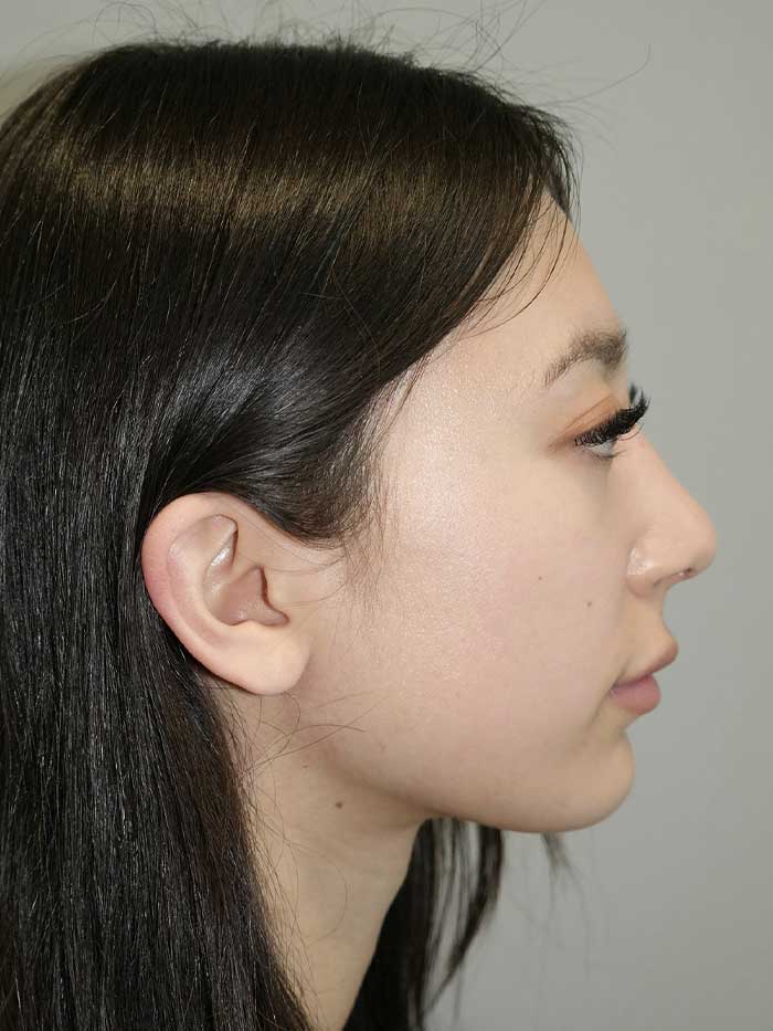 Rhinoplasty Before and After | Grover Aesthetics