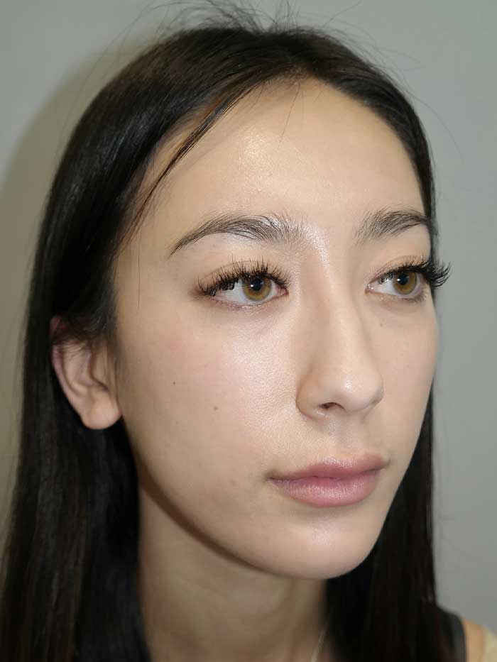 Rhinoplasty Before and After 02 | Grover Aesthetics