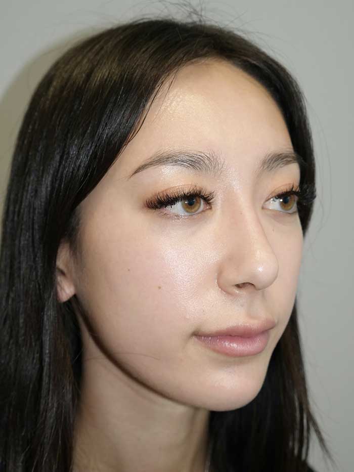 Rhinoplasty Before and After 02 | Grover Aesthetics