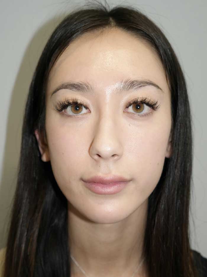 Rhinoplasty Before and After 02 | Grover Aesthetics