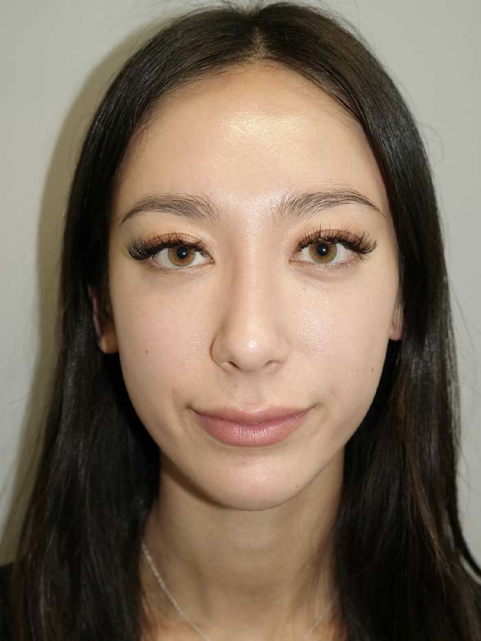 Rhinoplasty Before and After 02 | Grover Aesthetics