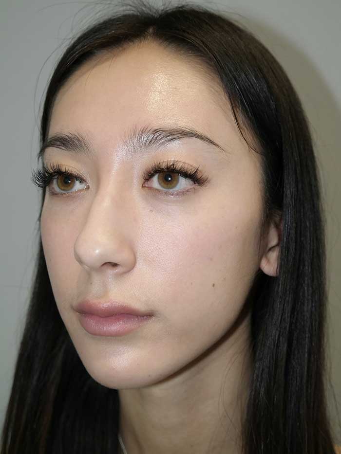 Rhinoplasty Before and After 02 | Grover Aesthetics