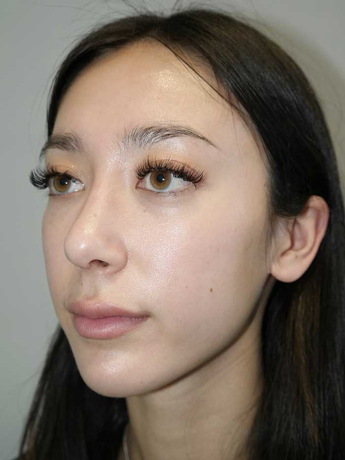 Rhinoplasty Before and After 02 | Grover Aesthetics