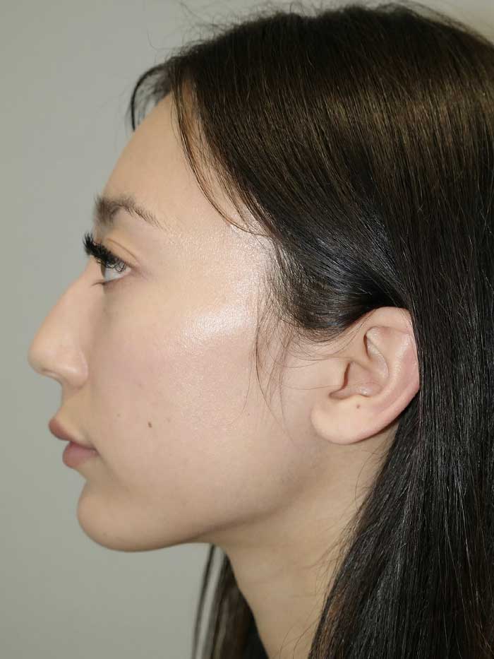 Rhinoplasty Before and After 02 | Grover Aesthetics