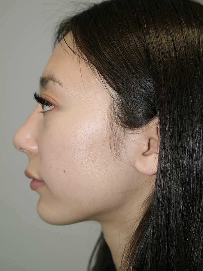 Rhinoplasty Before and After 02 | Sanjay Grover MD FACS