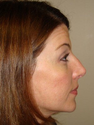 Rhinoplasty Before and After 45 | Sanjay Grover MD FACS