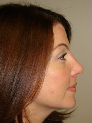 Rhinoplasty Before and After | Grover Aesthetics