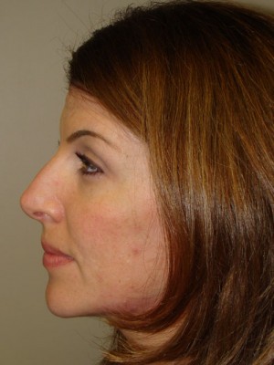 Rhinoplasty Before and After 03 | Sanjay Grover MD FACS