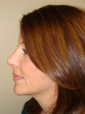 Rhinoplasty Before and After 03 | Grover Aesthetics