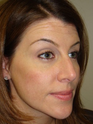 Rhinoplasty Before and After 03 | Grover Aesthetics
