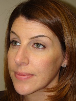 Rhinoplasty Before and After 03 | Grover Aesthetics