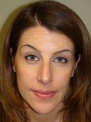 Rhinoplasty Before and After 03 | Grover Aesthetics